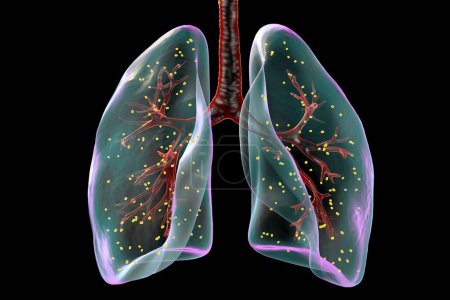 Téléchargez les photos : Adiaspiromycose pulmonaire, illustration 3D. - en image libre de droit