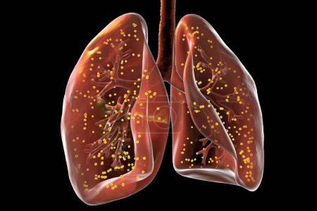 Téléchargez les photos : Poumons humains atteints de tuberculose miliaire, illustration. - en image libre de droit