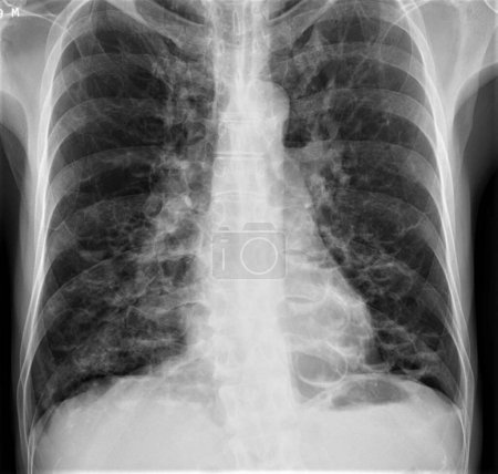Radiographie pulmonaire d'un patient atteint de bronchiectasie. La bronchiectasie est la dilatation et la distorsion permanentes des bronchioles (voies respiratoires pulmonaires).
