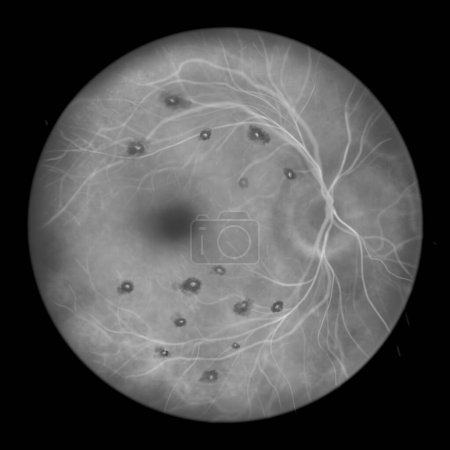 Foto de Ilustración de manchas de Roth en la retina observadas en la angiografía fluoresceínica, que muestran hemorragias de retina centradas en el blanco con anillos hemorrágicos circundantes. - Imagen libre de derechos