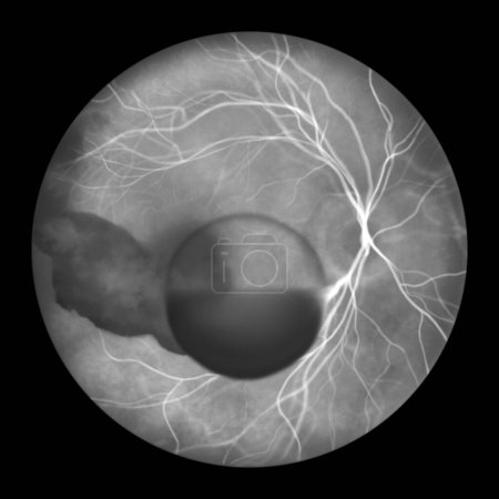 Foto de Ilustración que muestra el síndrome de Terson, revelando hemorragia intraocular observada durante la angiografía fluoresceínica, relacionada con hemorragia intracraneal o lesión cerebral traumática. - Imagen libre de derechos