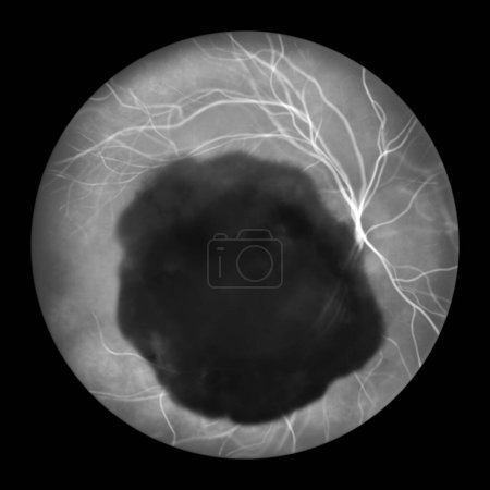 Foto de Ilustración de una hemorragia subretiniana observada durante la angiografía con fluoresceína, que revela una hemorragia oscura e irregular debajo de las capas retinianas. - Imagen libre de derechos
