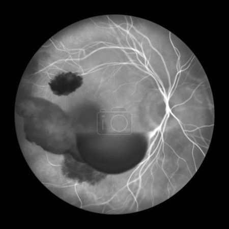Foto de Ilustración que muestra el síndrome de Terson, revelando hemorragia intraocular observada durante la angiografía fluoresceínica, relacionada con hemorragia intracraneal o lesión cerebral traumática. - Imagen libre de derechos