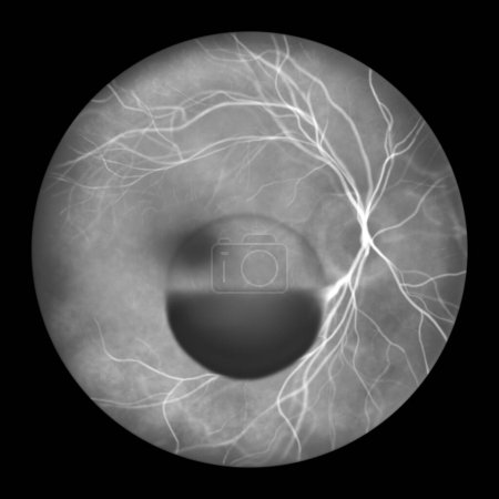 Photo for Illustration of a subhyaloid haemorrhage on the retina as observed during fluorescein angiography, showcasing a dark, dome-shaped haemorrhage beneath the hyaloid membrane. - Royalty Free Image