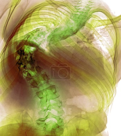 Téléchargez les photos : Radiographie colorée de la colonne vertébrale d'un patient souffrant de maux de dos montrant une scoliose sévère, une courbure latérale structurelle de la colonne vertébrale avec un composant rotatif. - en image libre de droit