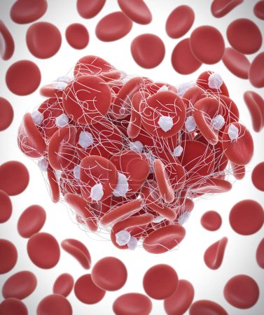 Téléchargez les photos : Illustration de globules rouges (érythrocytes) piégés dans un filet de fibrine (blanc) formant un caillot. La production de fibrine est déclenchée par des cellules appelées plaquettes, activées lorsqu'un vaisseau sanguin est endommagé. - en image libre de droit
