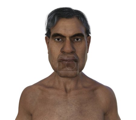 Foto de Ilustración que representa la acromegalia en un hombre. Hay un aumento en el tamaño de la cara con acromegalia debido a la sobreproducción de somatotropina causada por un tumor de la glándula pituitaria. - Imagen libre de derechos