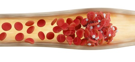 Foto de Ilustración de un vaso sanguíneo con glóbulos rojos (eritrocitos) atrapados en una malla de fibrina (blanca) formando un coágulo. La producción de fibrina es desencadenada por células llamadas plaquetas, activadas cuando un vaso sanguíneo está dañado.. - Imagen libre de derechos