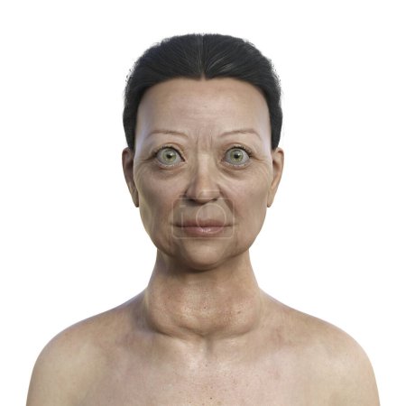 Téléchargez les photos : Illustration représentant une femme atteinte de la maladie de Graves montrant une hypertrophie de la glande thyroïde et une saillie anormale des globes oculaires (exophtalmie)). - en image libre de droit