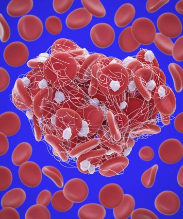 Photo for Illustration of red blood cells (erythrocytes) trapped in a fibrin mesh (white) forming a clot. The production of fibrin is triggered by cells called platelets, activated when a blood vessel is damaged. - Royalty Free Image