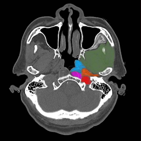 Foto de Tomografía axial computarizada de cabeza (TC) que muestra la anatomía del espacio profundo del cuello. El área verde es el espacio masticador, el área azul es el espacio de la mucosa faríngea, el área naranja es el espacio parafaríngeo. - Imagen libre de derechos
