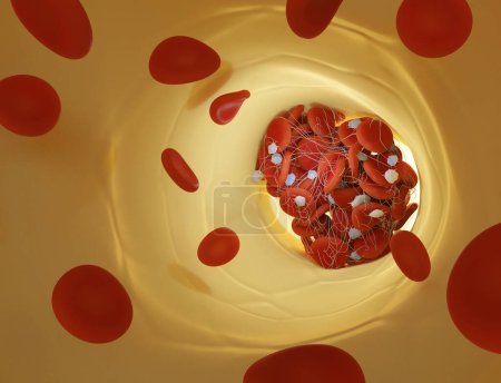 Téléchargez les photos : Illustration d'un vaisseau sanguin avec des globules rouges (érythrocytes) piégés dans un filet de fibrine (blanc) formant un caillot. La production de fibrine est déclenchée par des cellules appelées plaquettes, activées lorsqu'un vaisseau sanguin est endommagé. - en image libre de droit