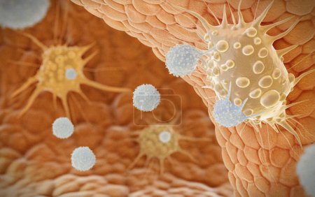 Téléchargez les photos : Illustration de cellules T (NKT) tueuses naturelles (grises) attaquant des cellules cancéreuses (orange). Les cellules NKT sont des lymphocytes (globules blancs) qui agissent dans le cadre de la réponse immunitaire innée (non spécifique) du corps.. - en image libre de droit