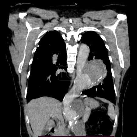 Photo for Contrast chest computed tomography (CT) scan of 54-year-old female patient showing saccular type enlargement of the descending thoracic aorta (centre). There is also calcification (white) on the aorta wall. - Royalty Free Image