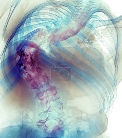 Photo for Coloured X-ray of the spine of a patient with back pain showing severe scoliosis, a structural lateral curvature of the spine with a rotatory component. - Royalty Free Image