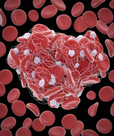 Foto de Ilustración de glóbulos rojos (eritrocitos) atrapados en una malla de fibrina (blanca) formando un coágulo. La producción de fibrina es desencadenada por células llamadas plaquetas, activadas cuando un vaso sanguíneo está dañado.. - Imagen libre de derechos