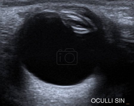 Photo for Ocular ultrasound of a 55-year old male with blurred vision, revealing opacities in the lens that are suggestive of a cataract. - Royalty Free Image