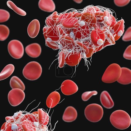 Téléchargez les photos : Illustration de globules rouges (érythrocytes) piégés dans un filet de fibrine (blanc) formant un caillot. La production de fibrine est déclenchée par des cellules appelées plaquettes, activées lorsqu'un vaisseau sanguin est endommagé. - en image libre de droit
