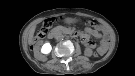 Photo for Axial abdominal computed tomography (CT) scan showing a hyperdense (bright) renal stone, or nephrolithiasis, in the right kidney. - Royalty Free Image
