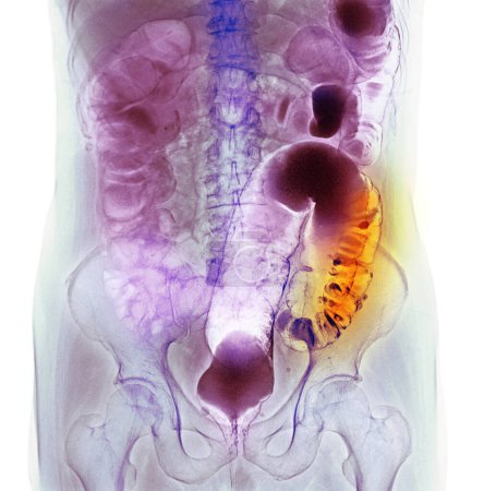 Photo for Coloured barium enema contrast X-ray showing colon diverticula. Diverticula are small bulging pouches that can form in the lining of the digestive tract, most often in the lower part of the large intestine or colon. - Royalty Free Image