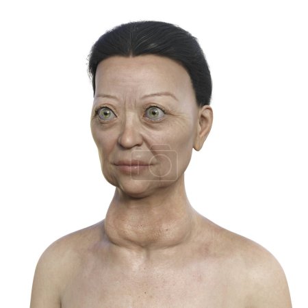 Photo for Illustration depicting a woman with Graves' disease showing an enlarged thyroid gland and abnormal protrusion of the eyeballs (exophthalmos). - Royalty Free Image