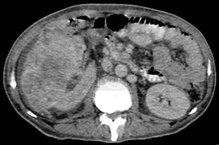 Téléchargez les photos : Tomodensitométrie axiale de l'abdomen avec contraste intraveineux chez un homme de 59 ans souffrant de douleurs abdominales. L'analyse révèle une masse hétérogène solide dans le rein droit suggérant un carcinome rénal (CCR) ou une tumeur de Grawitz.. - en image libre de droit