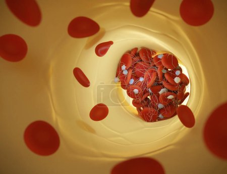Téléchargez les photos : Illustration d'un vaisseau sanguin avec des globules rouges (érythrocytes) piégés dans un filet de fibrine (blanc) formant un caillot. La production de fibrine est déclenchée par des cellules appelées plaquettes, activées lorsqu'un vaisseau sanguin est endommagé. - en image libre de droit