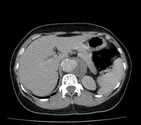 Foto de Tomografía axial computarizada (TC) de tórax de contraste de una paciente de 54 años que muestra un agrandamiento de la aorta abdominal (derecha). También hay calcificación en la pared aorta. - Imagen libre de derechos