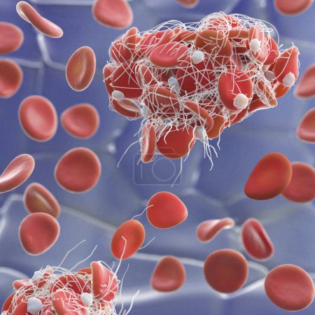 Illustration de globules rouges (érythrocytes) piégés dans un filet de fibrine (blanc) formant un caillot. La production de fibrine est déclenchée par des cellules appelées plaquettes, activées lorsqu'un vaisseau sanguin est endommagé. 