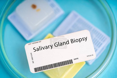 Biopsie des glandes salivaires. Un petit morceau de tissu glandulaire salivaire pour évaluer des affections telles que les tumeurs des glandes salivaires ou le syndrome de Sjogren.