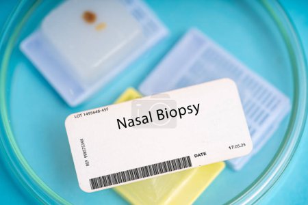 Téléchargez les photos : Biopsie nasale. Un petit morceau de tissu de la cavité nasale à évaluer pour des conditions telles que les polypes nasaux ou le cancer. - en image libre de droit