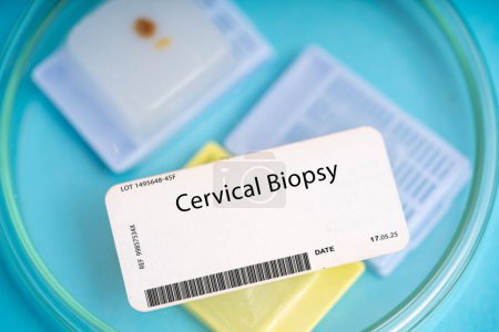 Téléchargez les photos : Biopsie cervicale. Un petit morceau de tissu du col de l'utérus à évaluer pour des conditions telles que le cancer du col de l'utérus ou des changements précancéreux. - en image libre de droit