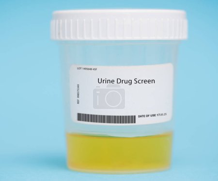 Téléchargez les photos : Dépistage urinaire. Ce test mesure la présence de drogues ou de leurs métabolites dans l'urine et est utilisé pour surveiller les niveaux de médicaments, détecter l'abus de drogues ou évaluer les interactions médicamenteuses.. - en image libre de droit