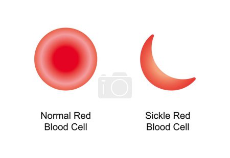 Normale und sichelrote Blutkörperchen, Abbildung.