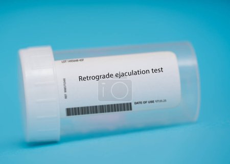 Téléchargez les photos : Retrograde ejaculation test. This test measures the amount of sperm in the urine after ejaculation. It is used to diagnose retrograde ejaculation, a condition where semen is ejaculated into the bladder instead of out of the penis. - en image libre de droit