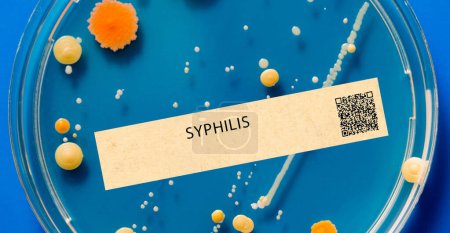 Syphilis. Dies ist eine sexuell übertragbare bakterielle Infektion, die Wunden und Hautausschlag verursachen kann.