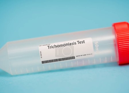 Téléchargez les photos : Trichomoniasis test. This test screens for a sexually transmitted infection called trichomoniasis. It involves taking a swab of the vagina and testing it for the presence of the parasite that causes the infection. - en image libre de droit