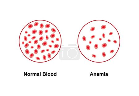 Scientific designing of Normal and anaemic blood, illustration.