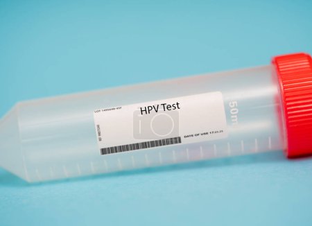 Téléchargez les photos : Test HPV. Le test VPH est un test de dépistage du virus du papillome humain (VPH), une infection transmissible sexuellement qui peut causer le cancer du col de l'utérus.. - en image libre de droit