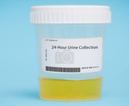 Photo for 24-hour urine collection. This test involves collecting all urine produced over a 24-hour period and measuring various substances in the sample, such as creatinine, electrolytes, and hormones. - Royalty Free Image