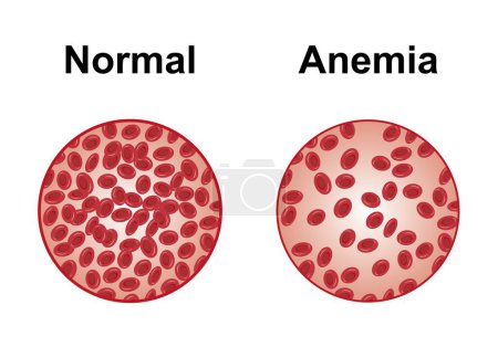 Normal and anaemic blood, illustration.
