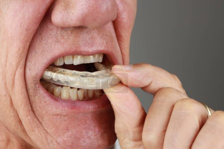 Photo for Older Mature Man putting in a night Guard in his mouth to prevent grinding - Royalty Free Image