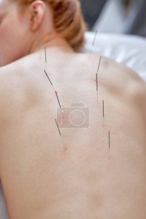 Téléchargez les photos : Acupuncture therapy on back spine shoulders for woman client. female undergoing acupuncture treatment with a line of fine needles inserted into slim body skin in clinic hospital, lying on couch - en image libre de droit