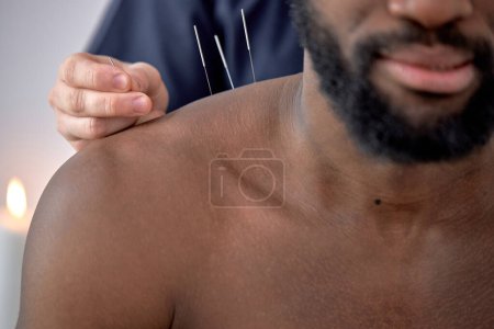 Téléchargez les photos : Hand of professional doctor performing acupuncture therapy for black male client. young man undergoing acupuncture treatment with a line of fine needles inserted into the body skin in clinic hospital - en image libre de droit