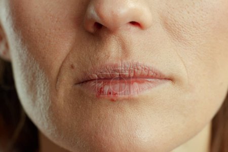 Photo for Closeup on middle aged woman with herpes on lips against beige background. - Royalty Free Image