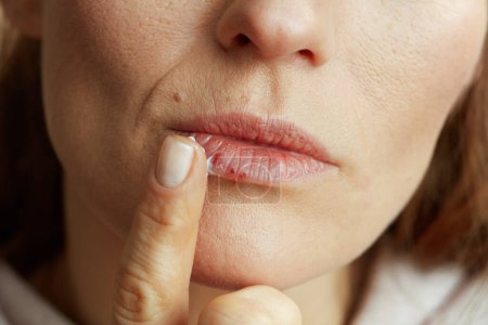 Foto de Closeup on female with herpes on lips applying ointment using finger on beige background. - Imagen libre de derechos