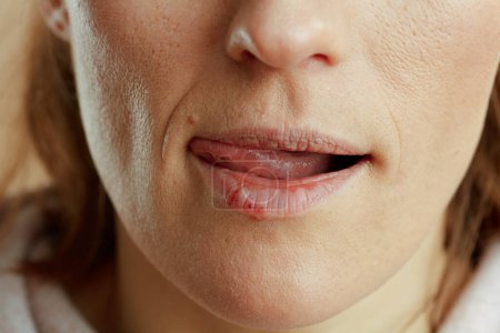Foto de Primer plano de la mujer con herpes lamiendo los labios sobre fondo beige. - Imagen libre de derechos
