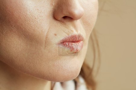 Foto de Primer plano de la mujer con herpes en los labios aislados sobre fondo beige. - Imagen libre de derechos