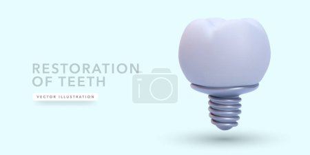 Dental implant in 3d realistic style isolated on light background. Vector illustration