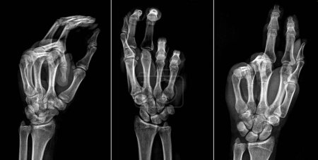 Foto de Fractura por rayos X de mano, dedos, subcapitata, quinto metacarpiano - Imagen libre de derechos